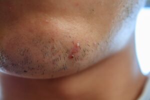 髭剃り後にニキビや肌荒れをした男性の顎